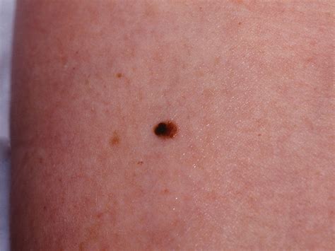 recurrence of melanoma in situ
